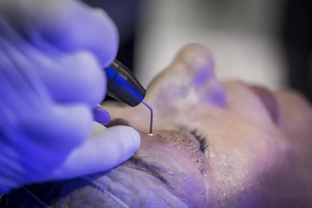 aplicacion-plasmage Blefaroplasma aplicación para rejuvenecer el contorno de los ojos con el equipo Plasmage